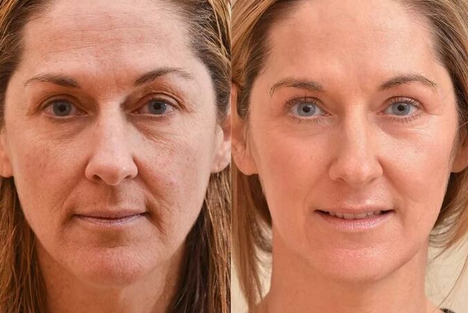 Rajeunissement du visage avant et après