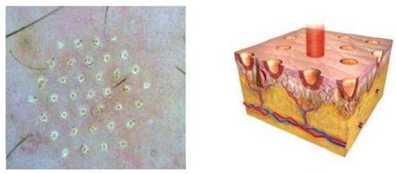 Le laser fractionnaire influence le point de peau