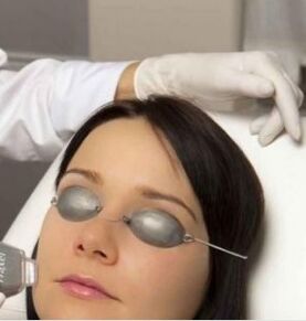 Rajeunissement du laser sur le terrain