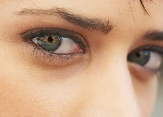Cercles sombres sous les yeux