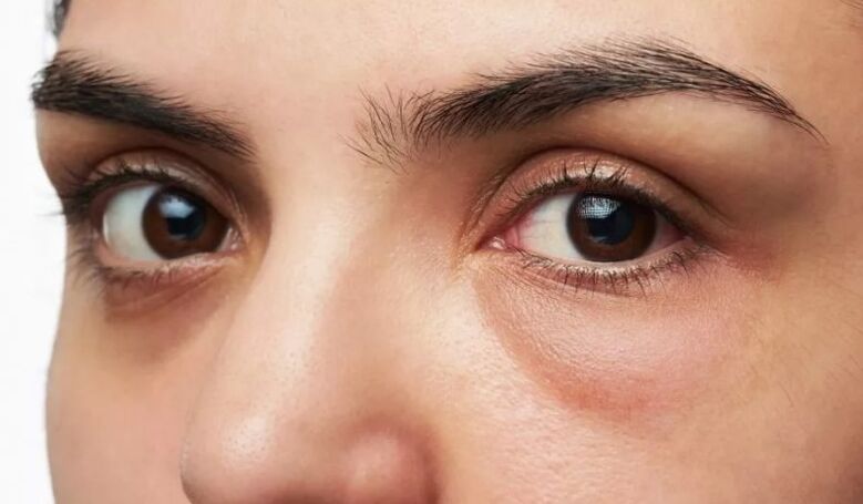 Sacs sous les yeux, gonflement