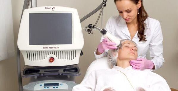 Rajeunissement fractionné de la peau au laser