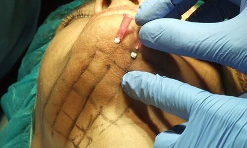 Le lifting des fils – une technique mini-invasive pour le rajeunissement de la peau du visage